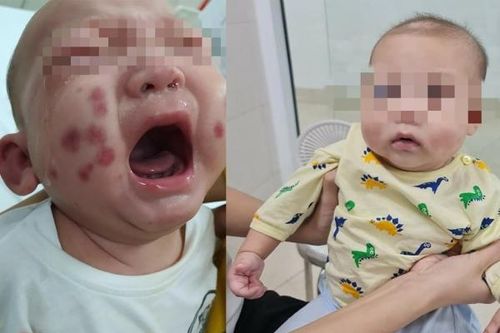 Bé trai 6 tháng tuổi mắc căn bệnh cực hiếm, chưa từng gặp ở Việt Nam