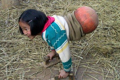 Sự thay đổi ngỡ ngàng của cô bé với nửa thân dưới là quả bóng rổ