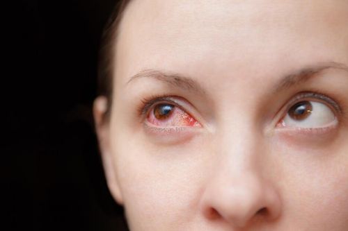 Những kiến thức cần biết về thuốc điều trị đau mắt đỏ cho phụ nữ mang thai?
