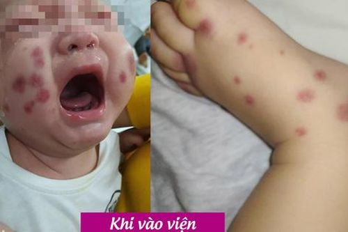 Bé 6 tháng tuổi mắc bệnh cực hiếm, Việt Nam chưa từng ghi nhận