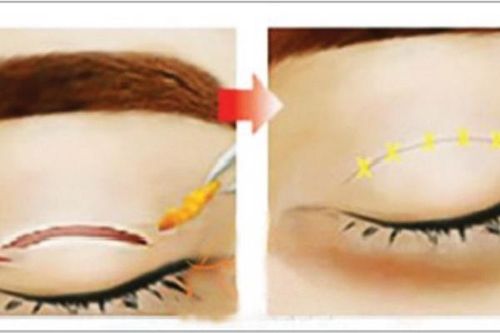 Hệ lụy khôn lường từ làm đẹp cho mắt