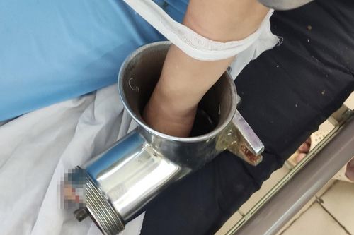 Cắt bỏ ngón giữa của bàn tay người làm bếp bị máy xay thịt cuốn