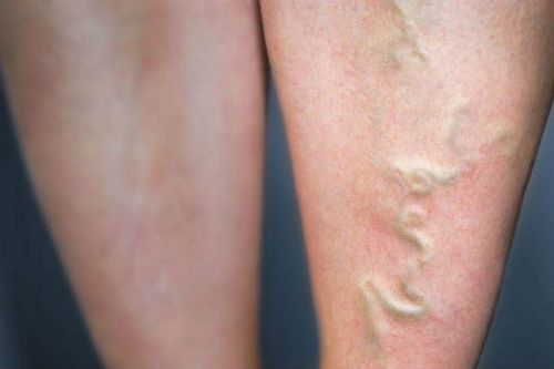 Bệnh lạ: Mạch máu nổi cuồn cuộn như rắn dưới da