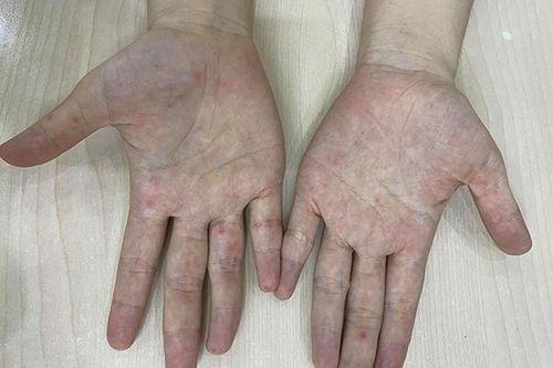 Người lớn chăm sóc trẻ mắc bệnh tay - chân - miệng: Không nên chủ quan