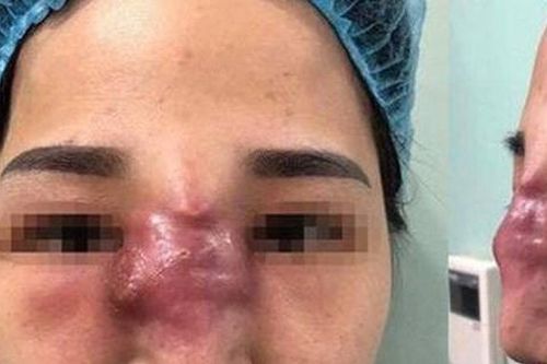 Biến chứng khi làm đẹp tại các cơ sở 'chui'