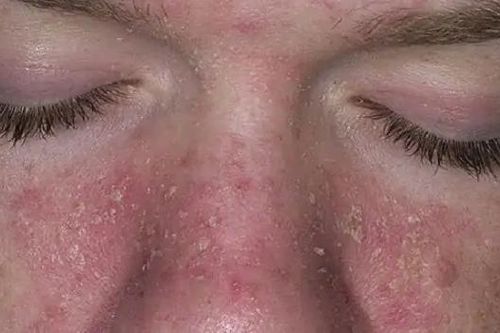 Bác sĩ da liễu cảnh báo bệnh về da dễ bị chẩn đoán nhầm