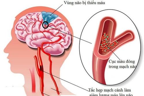 Cảnh giác với cơn thiếu máu não thoáng qua