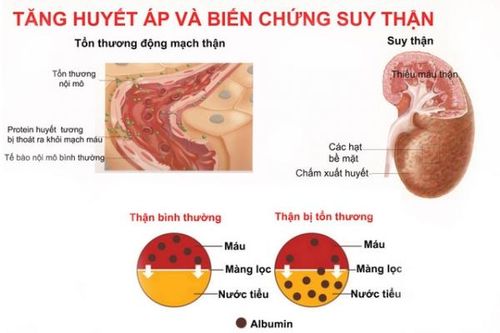 Dự phòng tăng huyết áp ở phụ nữ luống tuổi
