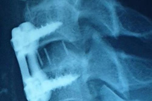 Bị trật đốt sống cổ vì đánh bóng bằng 'đầu'