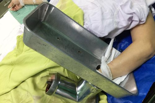 Giữ được 4 ngón của bàn tay dập nát do cuốn vào máy xay thịt