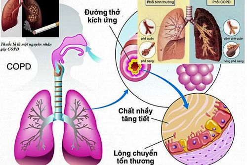 Người bị bệnh phổi tắc nghẽn mạn tính nên cai thuốc lá