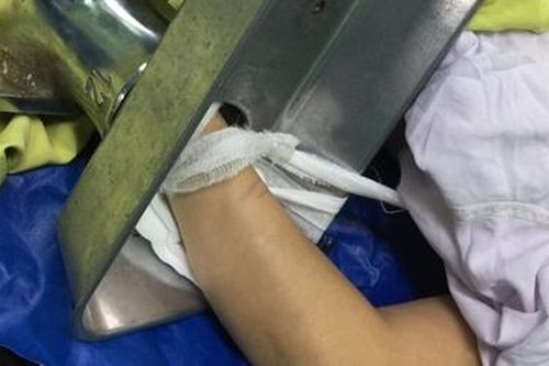 Người phụ nữ nhập viện với bàn tay trái trong máy xay thịt