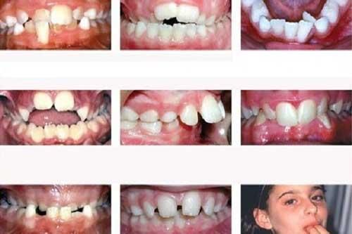 'Thủ phạm' bất ngờ gây răng mọc lệch ở trẻ nhỏ bất cứ bậc cha mẹ nào cũng nên biết