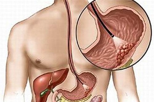 Chủ động tầm soát u Carcinoid đường tiêu hóa