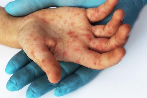 Bệnh tay chân miệng: Không chỉ lây qua đường hô hấp mà còn lây qua tiêu hóa