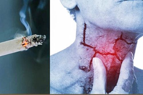Phòng ngừa ung thư vòm họng: Không sử dụng thuốc lá