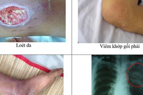Nhiễm khuẩn cấp do bệnh Whitmore có thể gây mất mạng trong 1 tuần