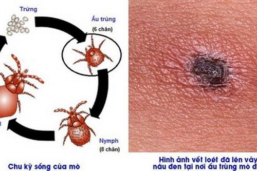 Nguy cơ tử vong do sốt mò