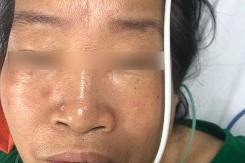 Bị ong lạ đốt, nữ bệnh nhân ở Hà Nội nhồi máu cơ tim cấp, ngừng tuần hoàn