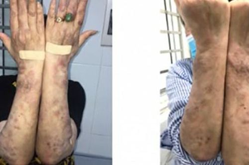 Không mất cảnh giác với bệnh phong