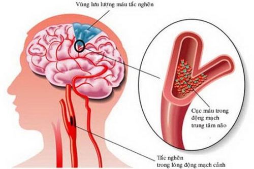 Nguy cơ tai biến mạch máu não do tăng huyết áp