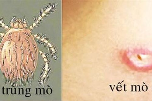Nguy hiểm sốt mò
