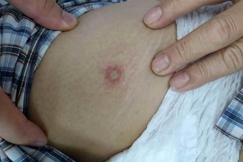 Sốc phản vệ do ong đốt