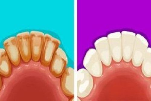 6 mẹo hay giúp loại bỏ mảng bám để có hàm răng trắng muốt