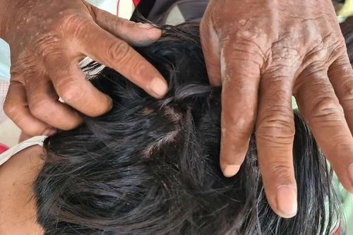 Nữ sinh bị đánh sau tai nạn ở Bình Dương phải khâu 10 mũi trên đầu
