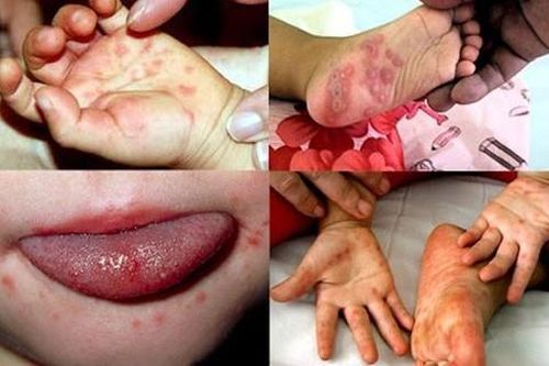 6 điều rất nhiều người đang hiểu sai về bệnh tay chân miệng