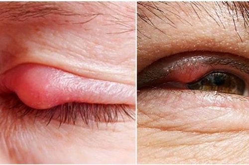 Nhận diện chắp và lẹo mắt