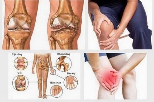 Đề phòng cứng khớp khi trở trời