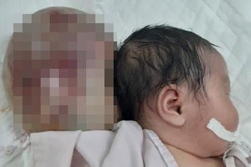 Bé trai có khối u to mọc sau đầu