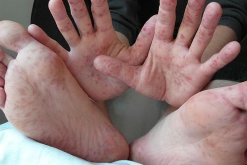 Bệnh tay chân miệng có lây không? Đối tượng nào dễ mắc bệnh?