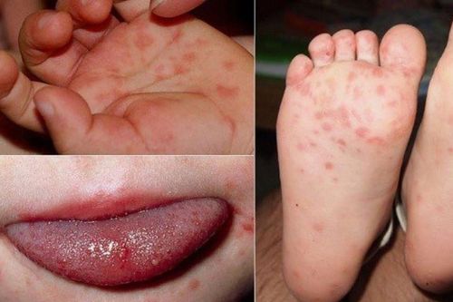 Hướng dẫn vệ sinh và chăm sóc các nốt tay chân miệng đúng cách?