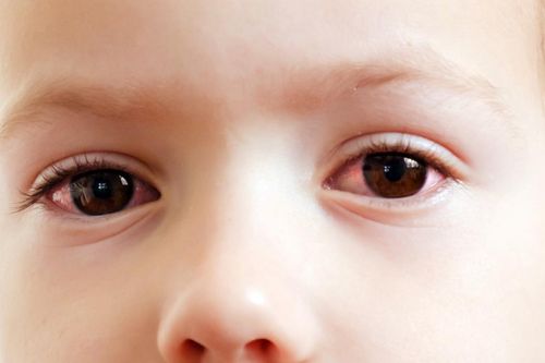Nguyên nhân gây đau mắt đỏ và nguy cơ làm giảm thị lực nguy hiểm