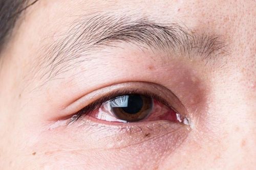 Thủ phạm khiến người phụ nữ chảy nước mắt suốt một năm