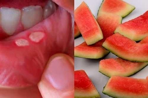 Trị nhiệt miệng hiệu quả chỉ bằng nguyên liệu có trong tủ lạnh