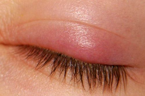 Sưng mi mắt: Đau mắt đỏ có phải nguyên nhân phổ biến nhất?