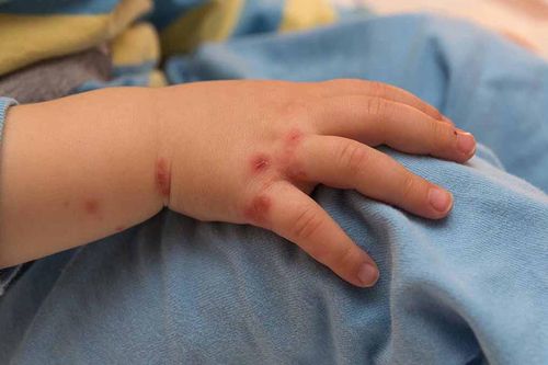 Những nguyên tắc cách ly khi bị tay chân miệng có thể bạn chưa biết