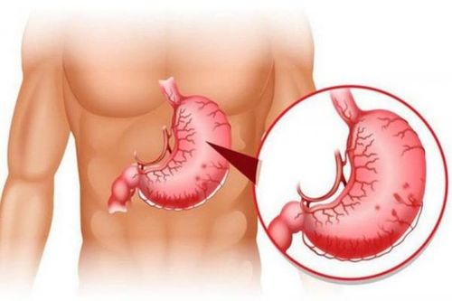 Nguyên nhân gây xuất huyết tiêu hóa