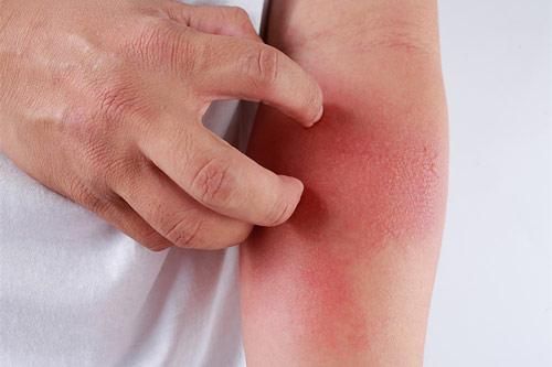 Người bị các bệnh sau không nên ăn cua đồng kẻo 'rước họa vào thân'