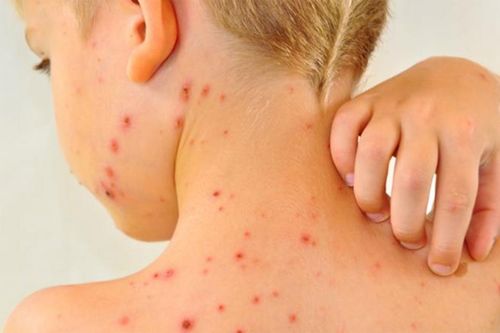 Làm sao để phòng tránh biến chứng của bệnh tay chân miệng?