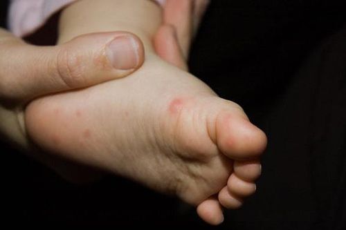 Chuyên gia y tế 'mách' cha mẹ cách tự kiểm tra bệnh tay chân miệng tại nhà cho trẻ cực đơn giản!