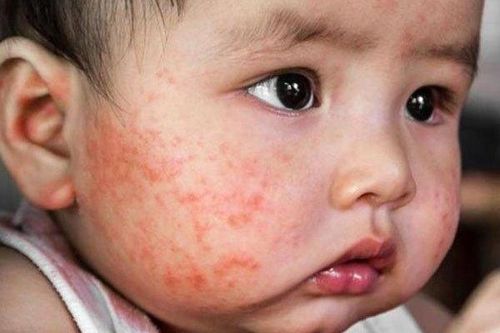 Kem chàm sữa cho trẻ: Những điều mẹ cần biết!
