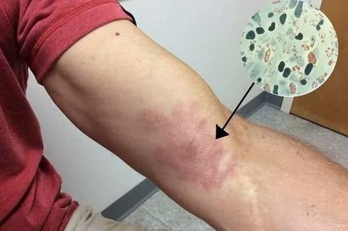 Từ ca mắc phong thể nhiều vi khuẩn giống Lupus ban đỏ Không mất cảnh giác với bệnh phong