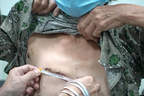 Thay van động mạch chủ và phình động mạch chủ bằng kỹ thuật mới