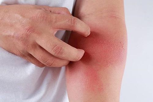 Nguyên nhân gây viêm da cơ địa và cách điều trị