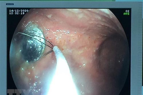 Cấp cứu kịp thời bé gái 4 tuổi nuốt phải đồng xu trong lúc chơi đùa