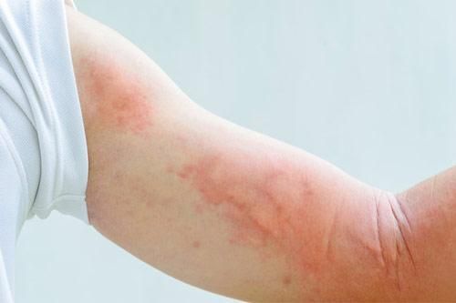 Trị chứng mề đay, mẩn ngứa đơn giản tại nhà khi giao mùa